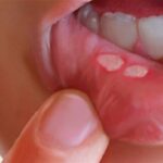 چگونه “آفْت دهان” خود را با چند راهکار طب سنتی درمان کنیم؟