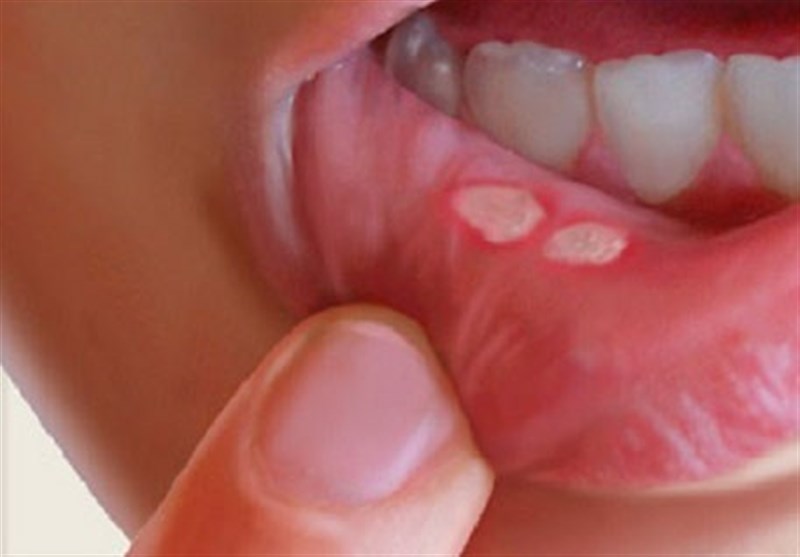 چگونه “آفْت دهان” خود را با چند راهکار طب سنتی درمان کنیم؟